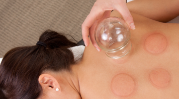 Cupping Therapy